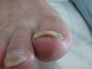 4カ月後　男性　陥入爪　春日井市