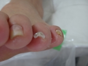 １ヶ月後　施術後　守山区