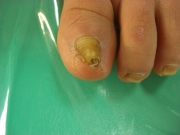 重度　巻き爪　女性