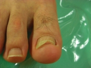 巻き爪　男性　陥入爪　春日井市