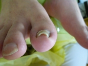 巻き爪　男性　陥入爪　春日井市