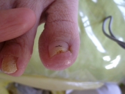 巻き爪　女性　陥入爪　尾張旭市