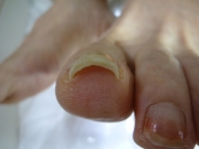 巻き爪　女性　陥入爪　春日井市