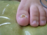 巻き爪　女性　陥入爪　尾張旭市