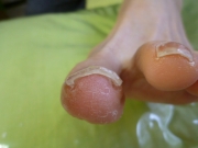 1カ月後　女性　陥入爪　春日井市