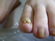 巻き爪　女性　春日井市