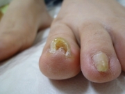 施術後　春日井市