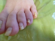 巻き爪　男性　守山区