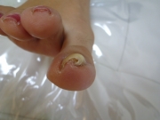 巻き爪　女性　守山区　看護師