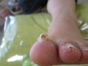 巻き爪　女性 40代　主婦