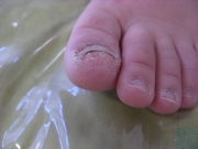 3ヶ月後　女性　陥入爪　尾張旭市