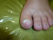 1ヶ月後　女性　陥入爪　尾張旭市