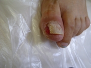 巻き爪　女性　肉芽　陥入爪　尾張旭市