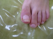 1ヶ月後　女性　肉芽　陥入爪　尾張旭市