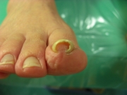 巻き爪　女性 ７0代　主婦