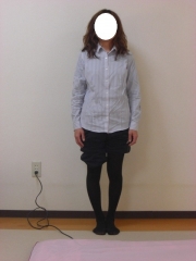 O脚矯正　女性　before