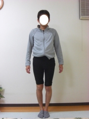 O脚矯正　30代　男性　before