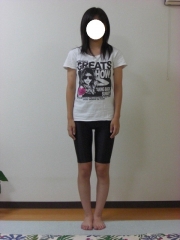 O脚矯正　15歳　女性　before