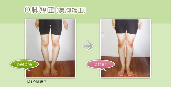 O脚矯正 美脚矯正 骨盤ダイエット 最新の陥入爪 巻き爪補正は愛知県尾張旭市の 北斗整体院 O脚矯正 美脚矯正 骨盤ダイエット 最新の陥入爪 巻き爪補正は愛知県尾張旭市の 北斗整体院