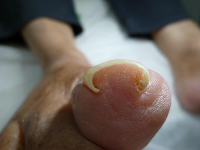 巻き爪 陥入爪 実証例1 骨盤ダイエット 最新の陥入爪 巻き爪補正は愛知県尾張旭市の 北斗整体院